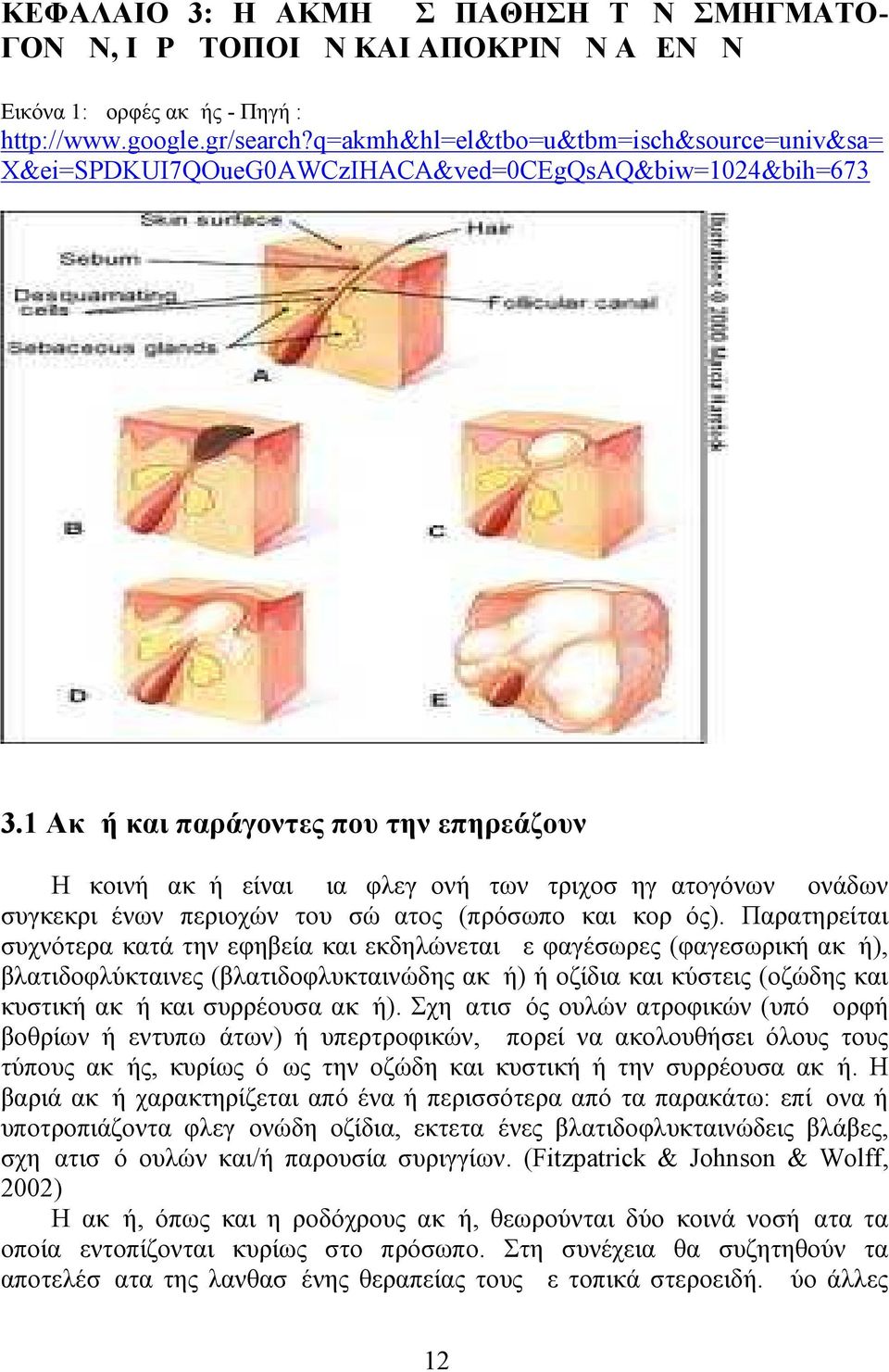 1 Ακμή και παράγοντες που την επηρεάζουν Η κοινή ακμή είναι μια φλεγμονή των τριχοσμηγματογόνων μονάδων συγκεκριμένων περιοχών του σώματος (πρόσωπο και κορμός).