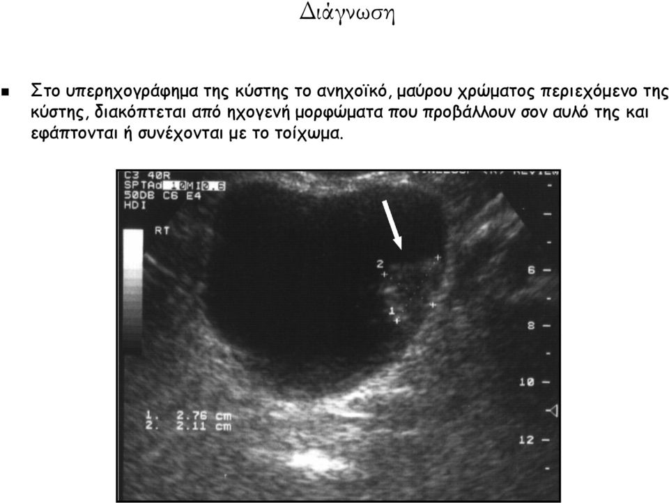 κύστης, διακόπτεται από ηχογενή μορφώματα που