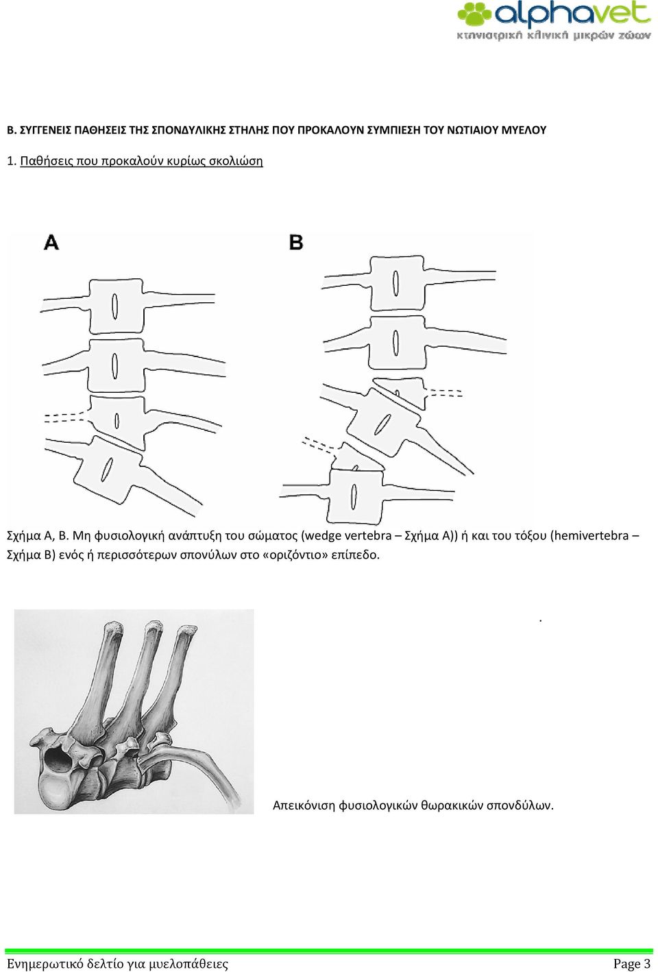Μη φυσιολογική ανάπτυξη του σώματος (wedge vertebra Σχήμα Α)) ή και του τόξου (hemivertebra
