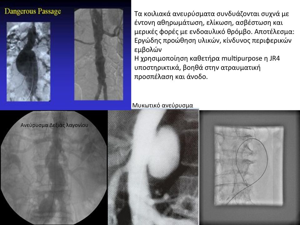 αποτέλεσμα: Εργώδηςπροώθησηυλικών,κίνδυνοςπεριφερικών εμβολών