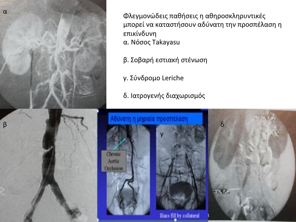 επικίνδυνη α.νόσοςtakayasu β.