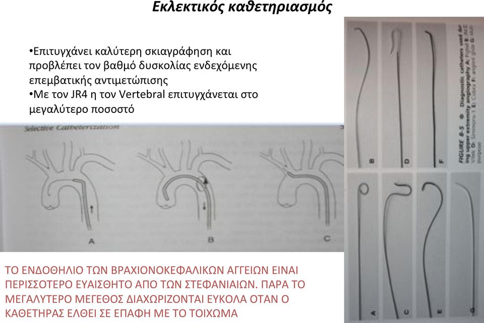 ΜετονJR4ητονVertebralεπιτυγχάνεταιστο μεγαλύτεροποσοστό