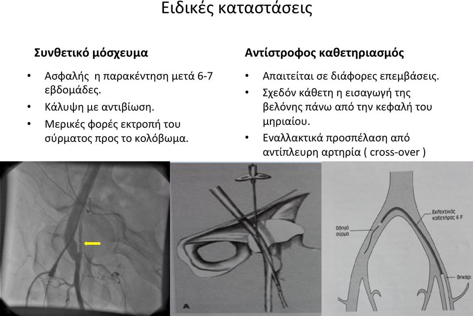 Αντίστροφος(καθετηριασμός( Απαιτείταισεδιάφορεςεπεμβάσεις.