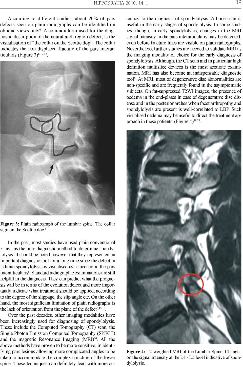 The collar indicates the non displaced fracture of the pars interarticularis (Figure 3) 6,17,18.