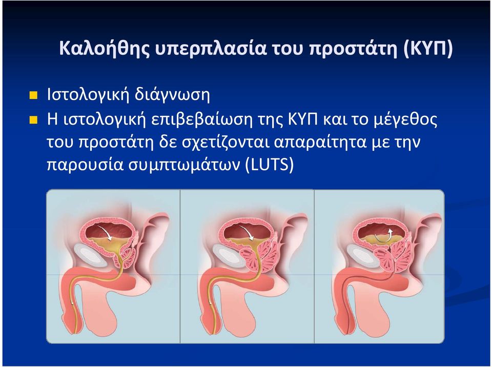 της ΚΥΠ και το μέγεθος του προστάτη δε