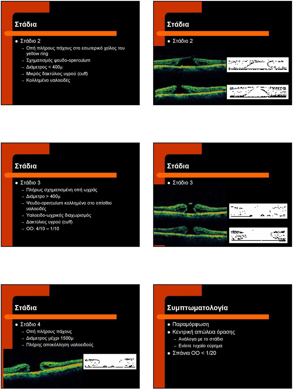 οπίσθιο υαλοειδές Υαλοειδο-ωχρικός διαχωρισµός ακτύλιος υγρού (cuff) ΟΟ: 4/10 1/10 Στάδιο 3 Στάδια Συµπτωµατολογία Στάδιο 4 Οπή πλήρους