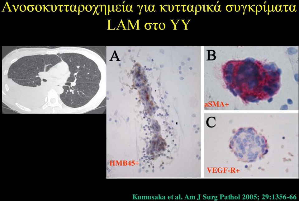 asma+ ΗΜΒ45+ VEGF-R+ Kumusaka