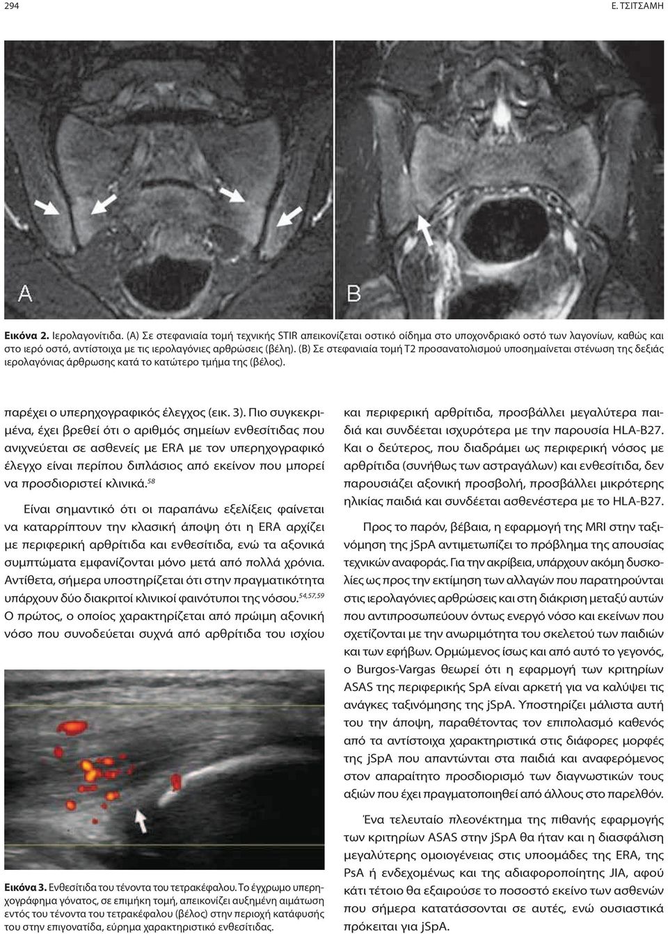 (Β) Σε στεφανιαία τομή Τ2 προσανατολισμού υποσημαίνεται στένωση της δεξιάς ιερολαγόνιας άρθρωσης κατά το κατώτερο τμήμα της (βέλος). παρέχει ο υπερηχογραφικός έλεγχος (εικ. 3).