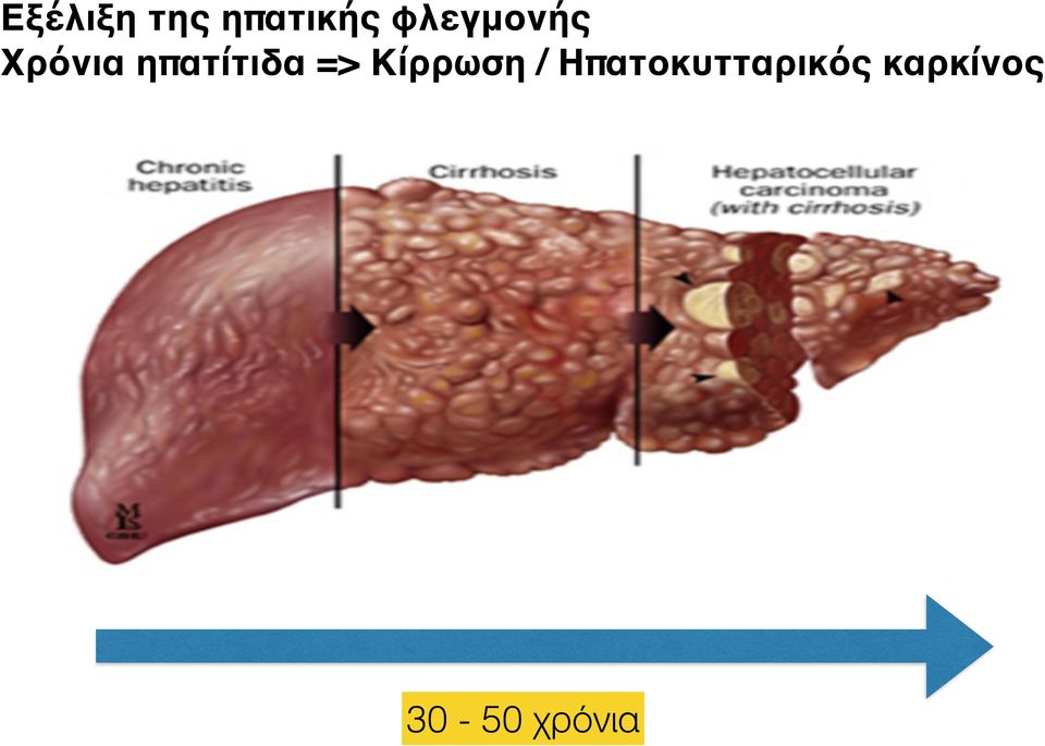 επέκταση της φλεγµονής εντός του ηπατικού λοβίου (interface hepatitis) συρρέουσα