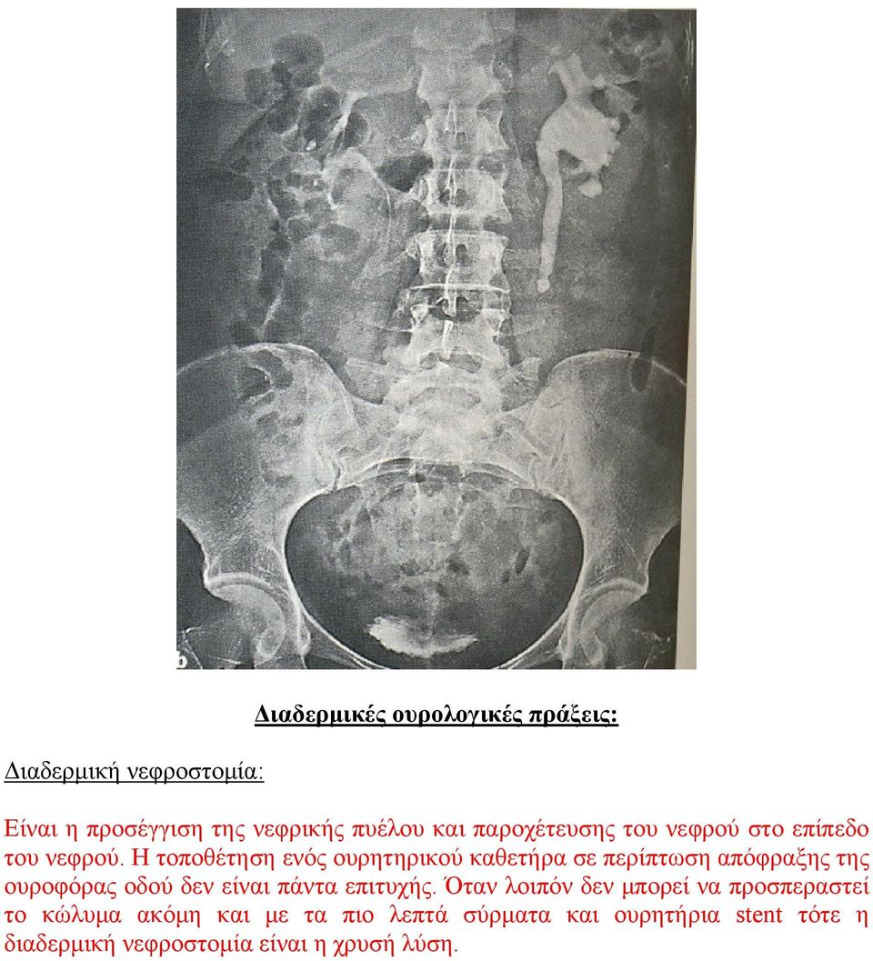 Η τοποθέτηση ενός ουρητηρικού καθετήρα σε περίπτωση απόφραξης της ουροφόρας οδού δεν είναι πάντα