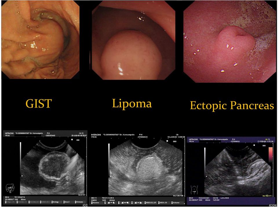 Ectopic