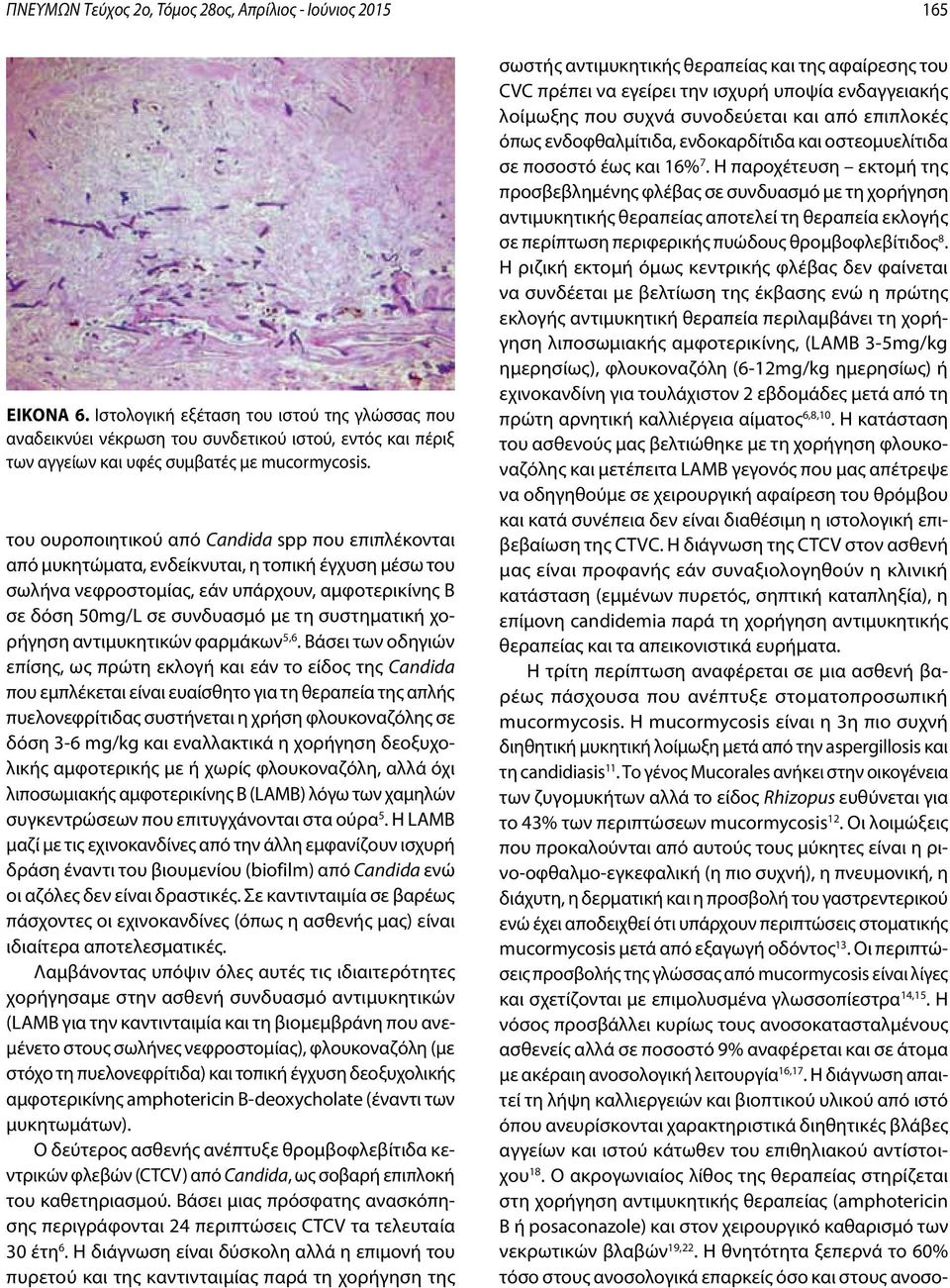 του ουροποιητικού από Candida spp που επιπλέκονται από μυκητώματα, ενδείκνυται, η τοπική έγχυση μέσω του σωλήνα νεφροστομίας, εάν υπάρχουν, αμφοτερικίνης Β σε δόση 50mg/L σε συνδυασμό με τη