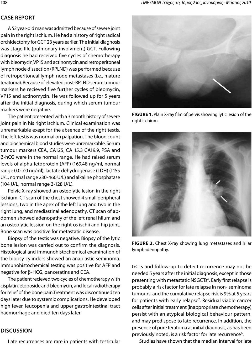 Following diagnosis he had received five cycles of chemotherapy with bleomycin,vp15 and actinomycin,and retroperitoneal lymph node dissection (RPLND) was performed because of retroperitoneal lymph