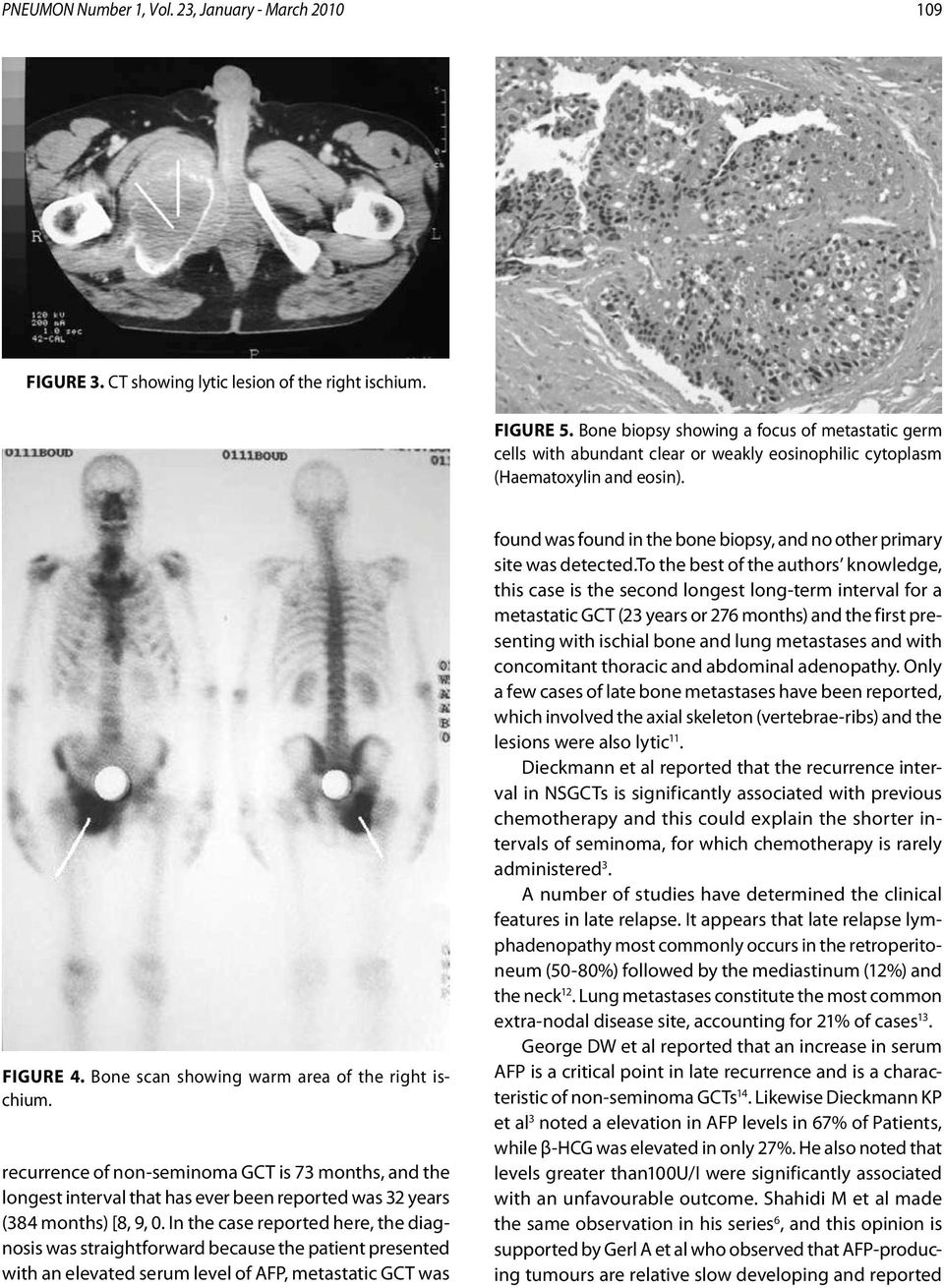 recurrence of non-seminoma GCT is 73 months, and the longest interval that has ever been reported was 32 years (384 months) [8, 9, 0.