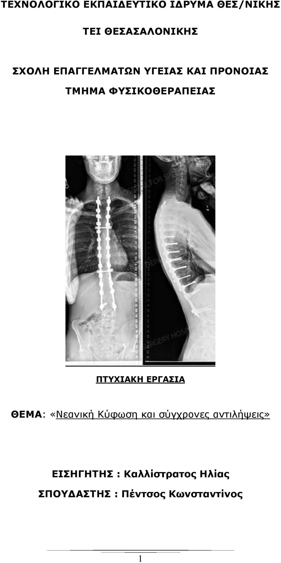 ΠΤΥΧΙΑΚΗ ΕΡΓΑΣΙΑ ΘΕΜΑ: «Νεανική Κύφωση και σύγχρονες