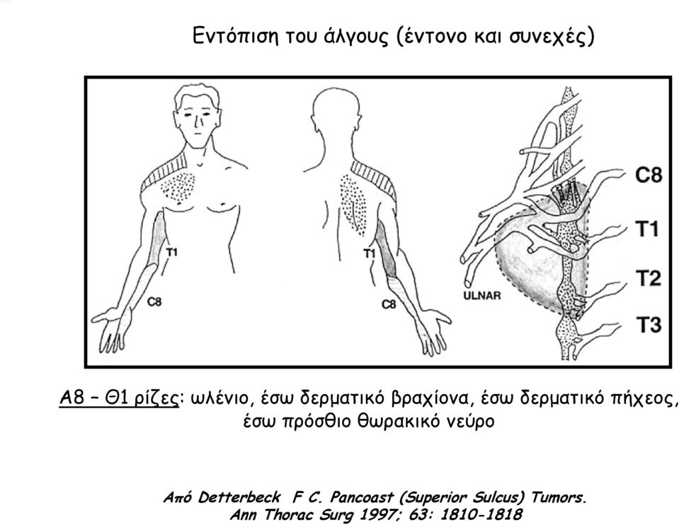 έσω πρόσθιο θωρακικό νεύρο Από Detterbeck F C.