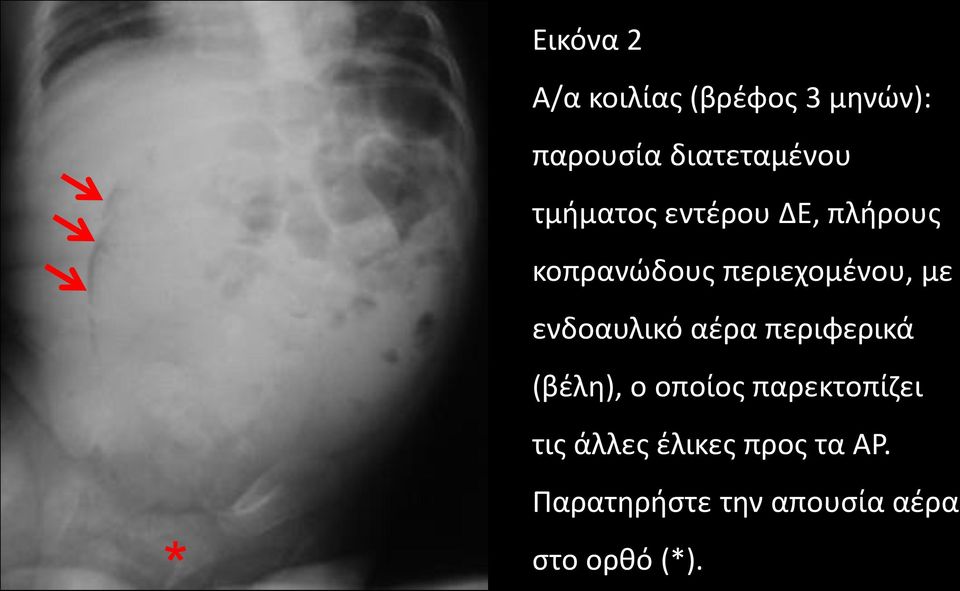 ενδοαυλικό αέρα περιφερικά (βέλη), ο οποίος παρεκτοπίζει τις