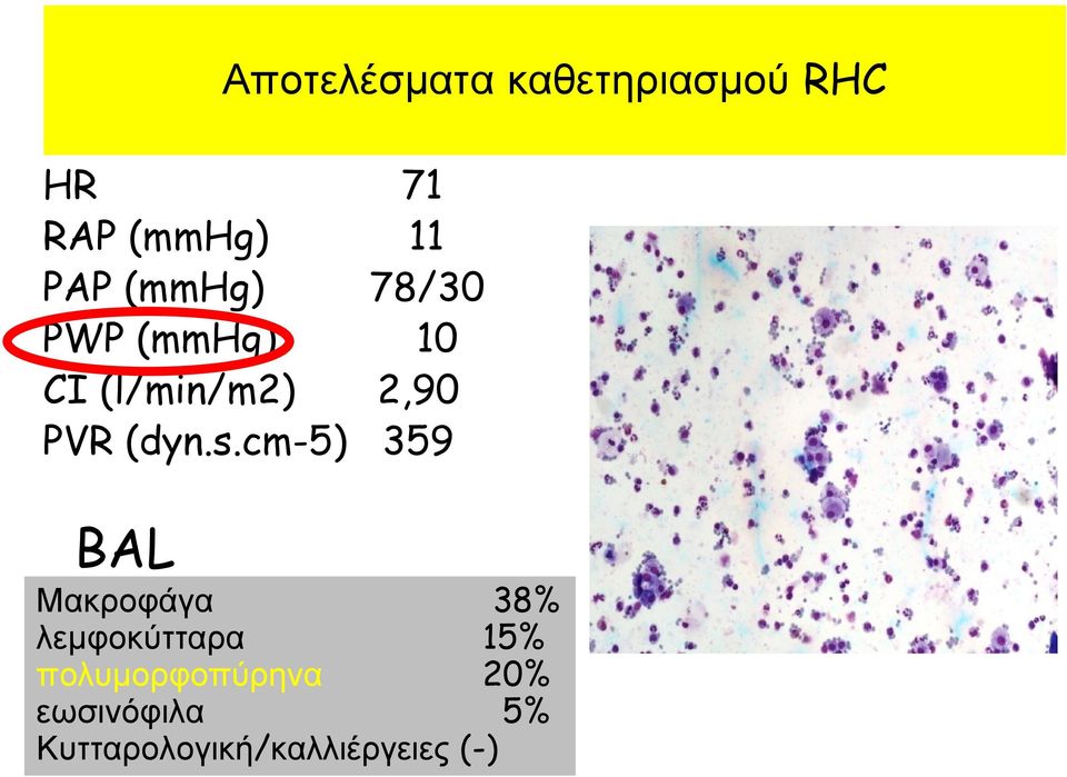 s.cm-5) 359 BAL Μακροφάγα 38% λεμφοκύτταρα 15%