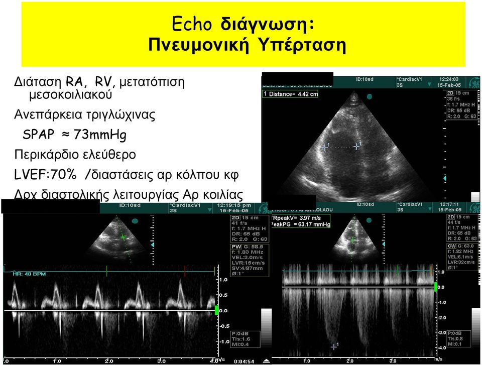 ελεύθερο LVEF:70% /διαστάσεις αρ κόλπου κφ Δρχ