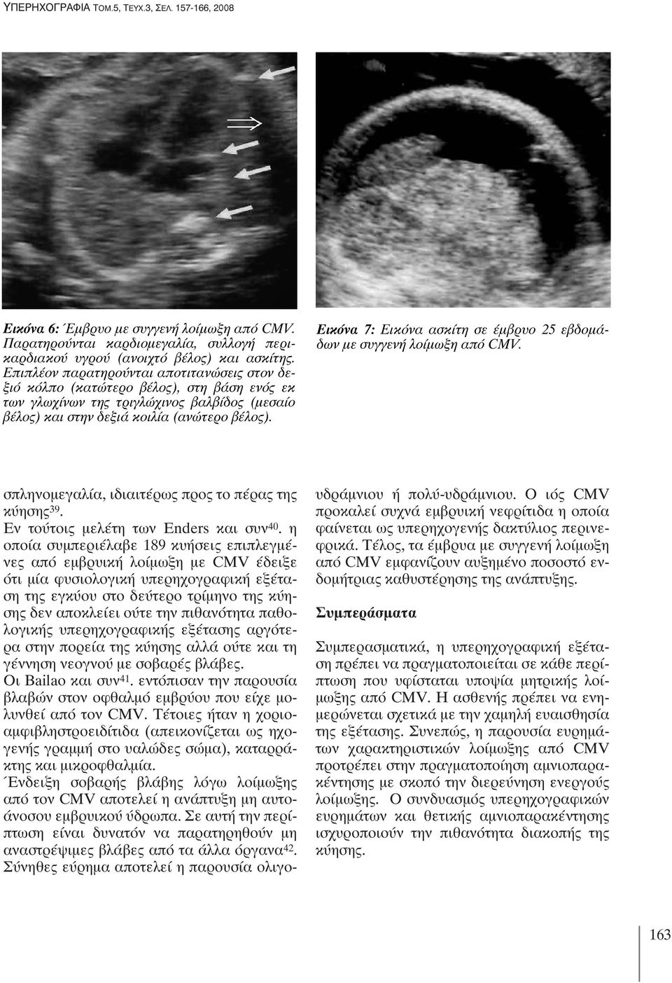Εικόνα 7: Εικόνα ασκίτη σε έμβρυο 25 εβδομάδων με συγγενή λοίμωξη από CMV. σπληνομεγαλία, ιδιαιτέρως προς το πέρας της κύησης 39. Εν τούτοις μελέτη των Enders και συν 40.