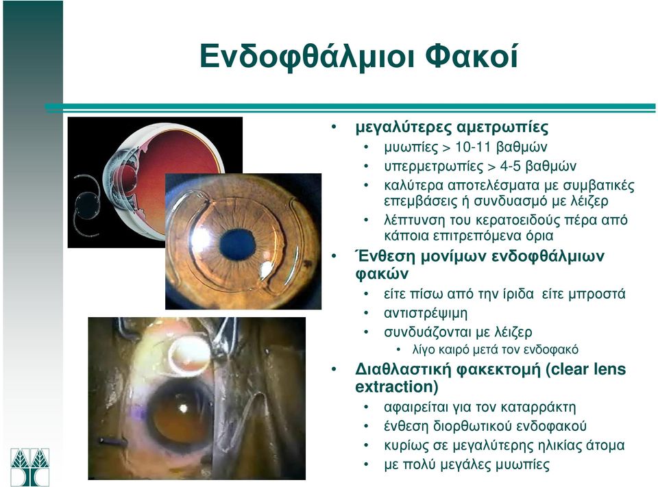 είτε πίσω από την ίριδα είτε µπροστά αντιστρέψιµη συνδυάζονται µε λέιζερ λίγο καιρό µετά τον ενδοφακό ιαθλαστική φακεκτοµή (clear