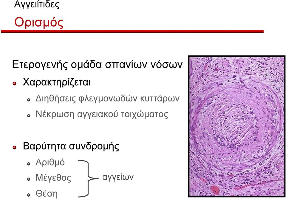 Διηθήσεις φλεγµονωδών κυττάρων!