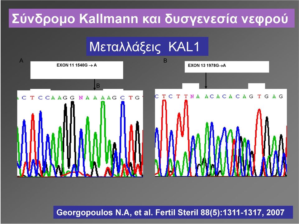 KAL1 B EXON 13 1978G A B Georgopoulos