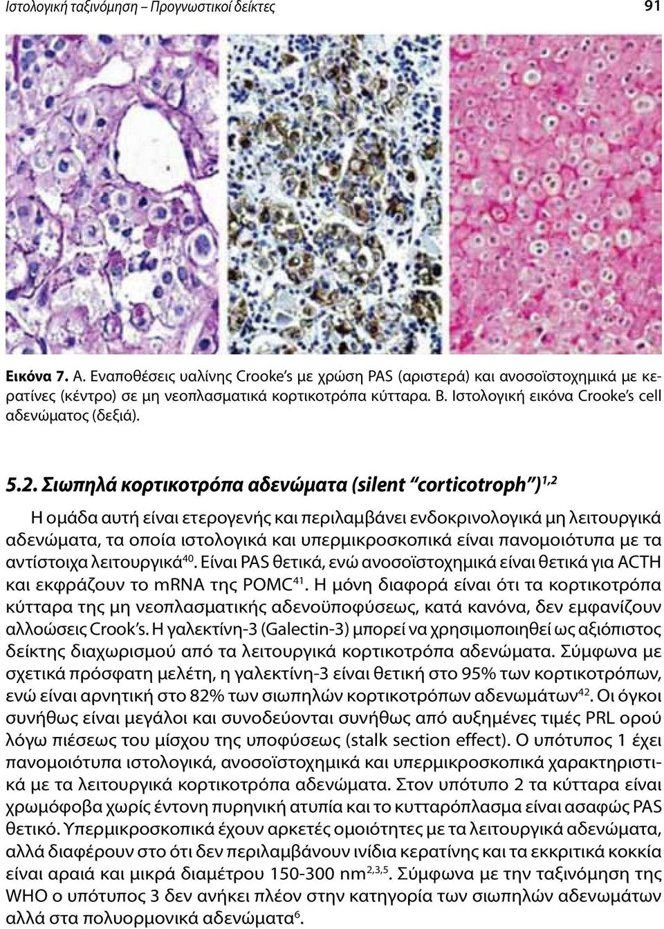 Σιωπηλά κορτικοτρόπα αδενώματα (silent corticotroph ) 1,2 Η ομάδα αυτή είναι ετερογενής και περιλαμβάνει ενδοκρινολογικά μη λειτουργικά αδενώματα, τα οποία ιστολογικά και υπερμικροσκοπικά είναι