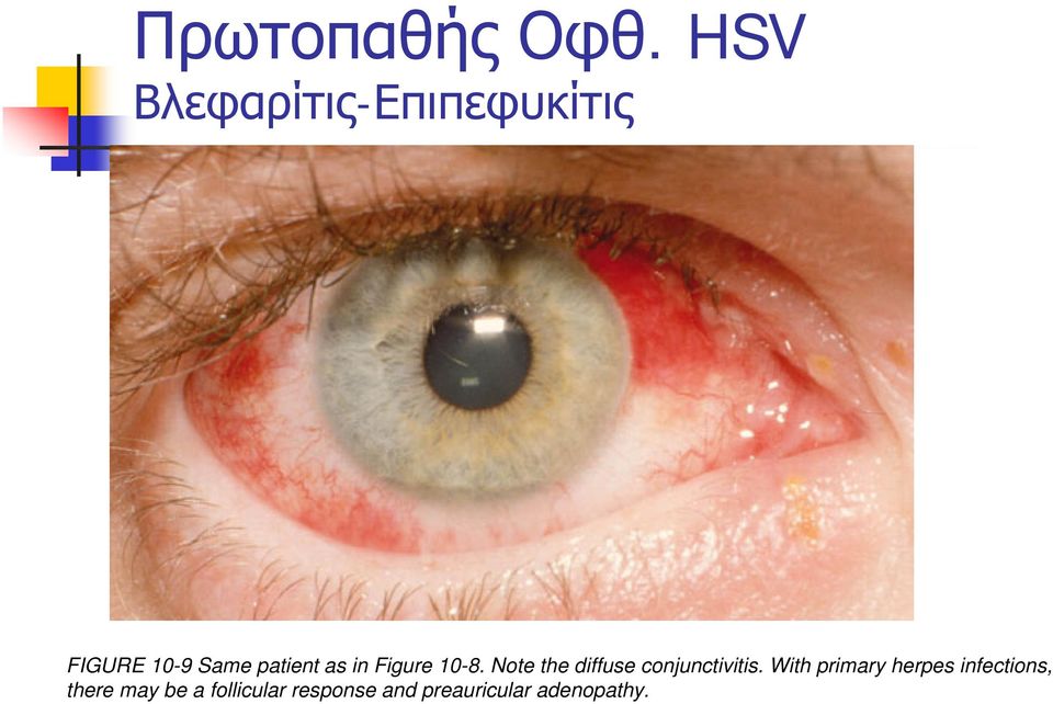 as in Figure 10-8. Note the diffuse conjunctivitis.
