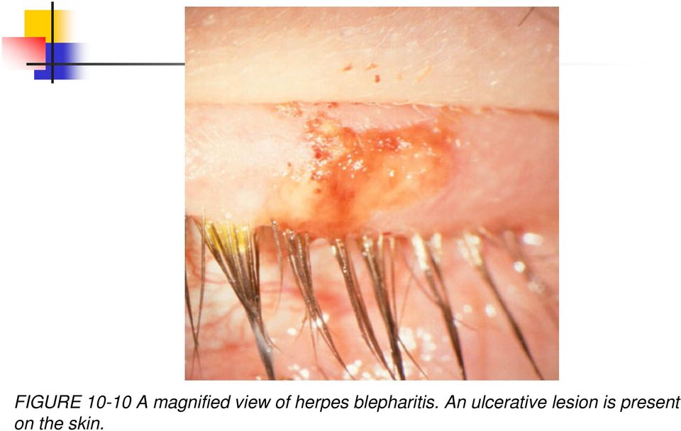 blepharitis.