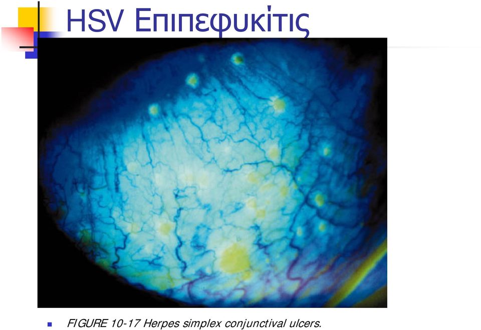 Herpes simplex