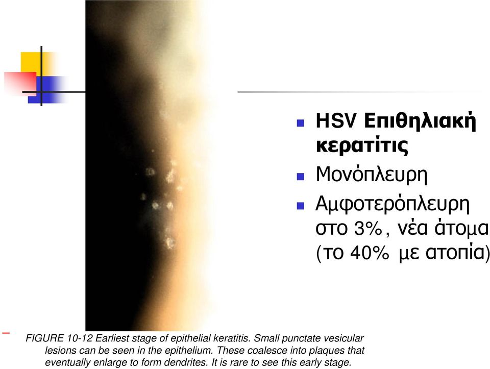 Small punctate vesicular lesions can be seen in the epithelium.