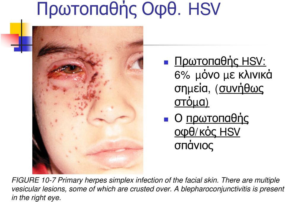 πρωτοπαθής οφθ/κός HSV σπάνιος FIGURE 10-7 Primary herpes simplex