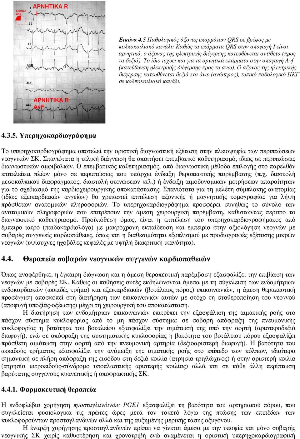 Το ίδιο ισχύει και για τα αρνητικά επάρµατα στην απαγωγή Avf (κατεύθυνση ηλεκτρικής διέγερσης προς τα άνω).