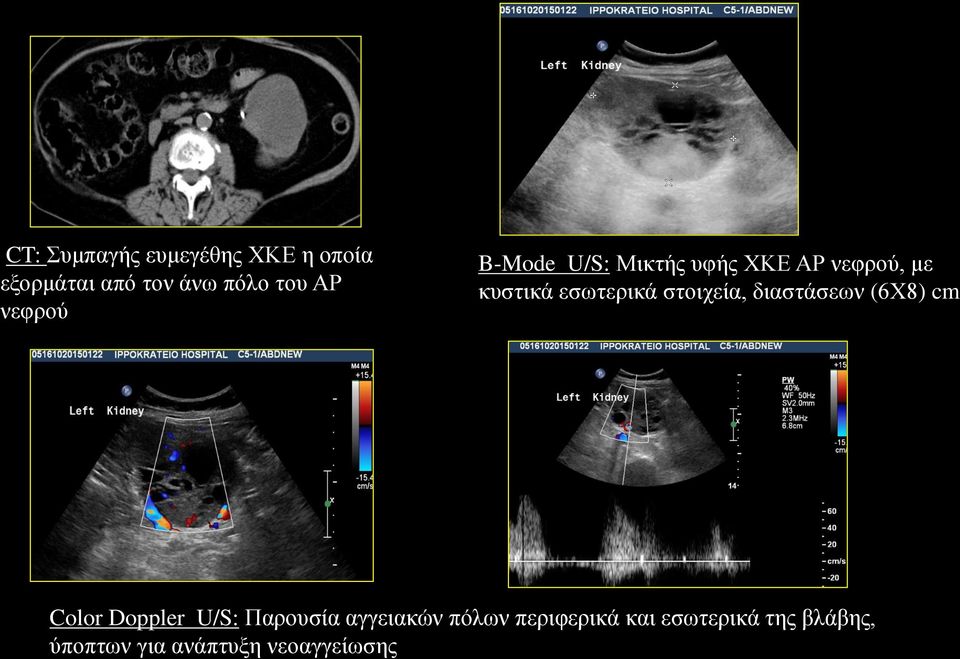 στοιχεία, διαστάσεων (6Χ8) cm Color Doppler U/S: Παρουσία αγγειακών