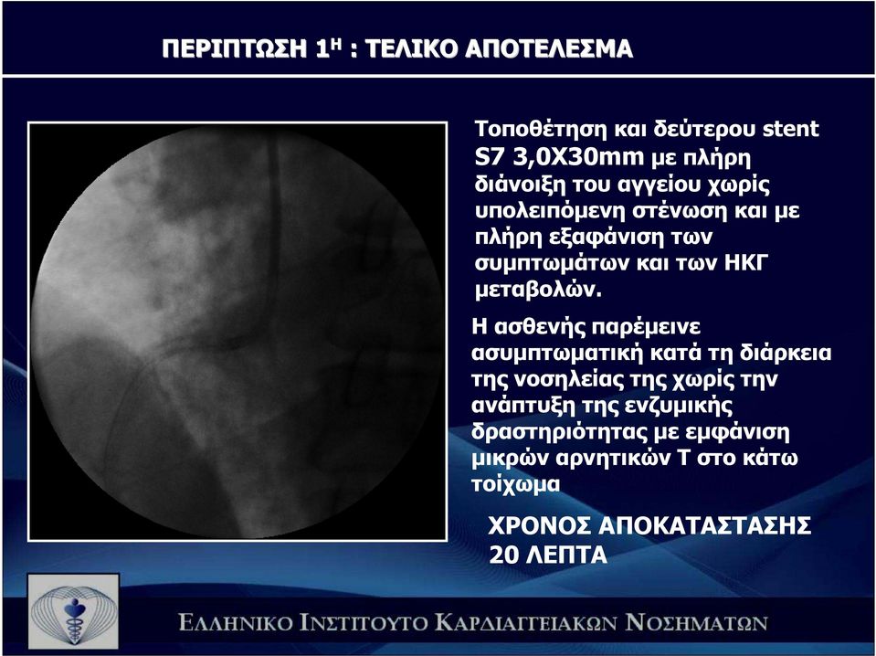 Η ασθενής παρέµεινε ασυµπτωµατική κατά τη διάρκεια της νοσηλείας της χωρίς την ανάπτυξη της