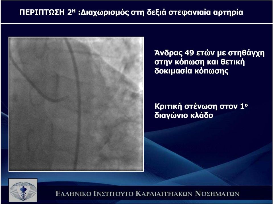 στηθάγχη στην κόπωση και θετική