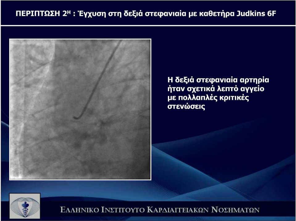 δεξιά στεφανιαία αρτηρία ήταν σχετικά