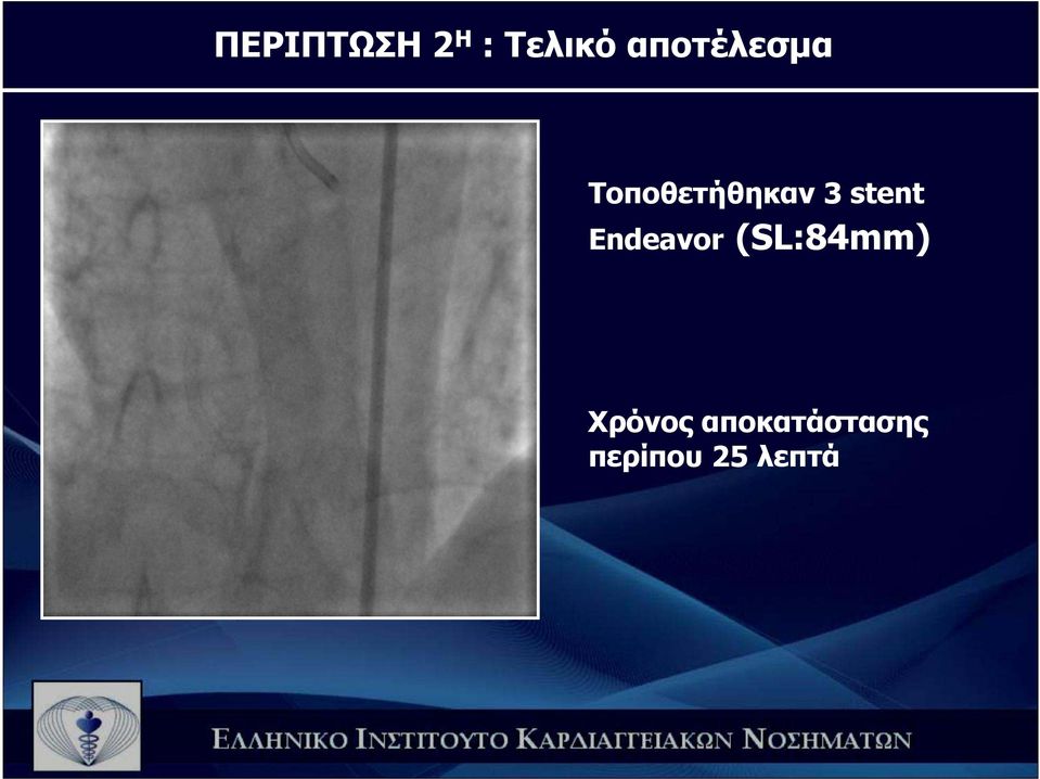 stent Endeavor (SL:84mm)