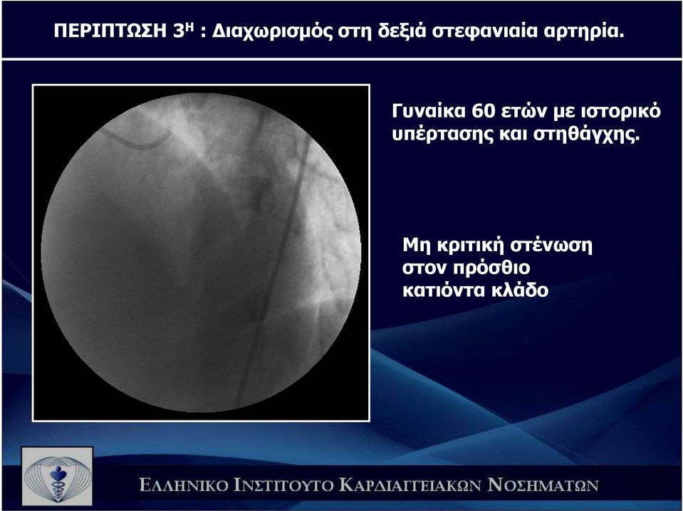 Γυναίκα 60 ετών µε ιστορικό υπέρτασης