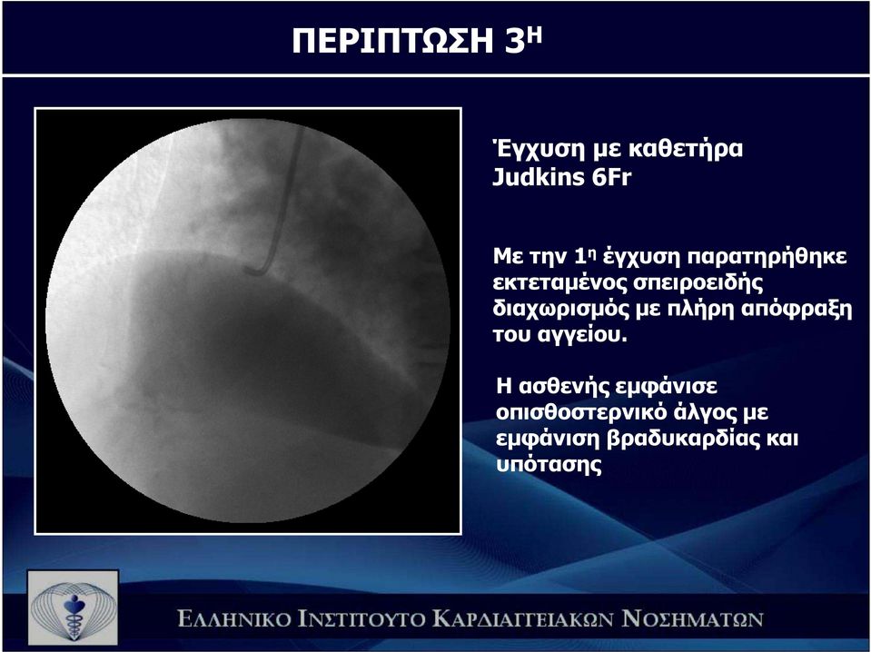 διαχωρισµός µε πλήρη απόφραξη του αγγείου.
