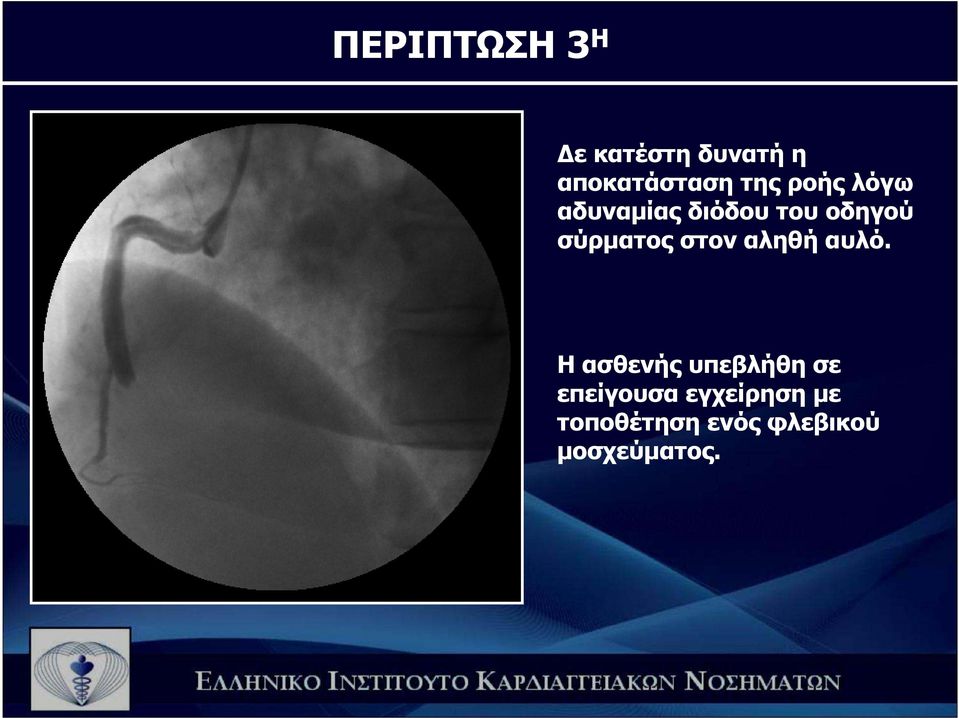 σύρµατος στον αληθή αυλό.