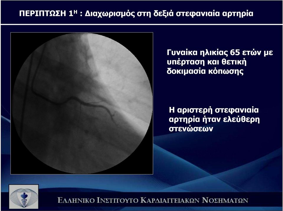 µε υπέρταση και θετική δοκιµασία κόπωσης Η