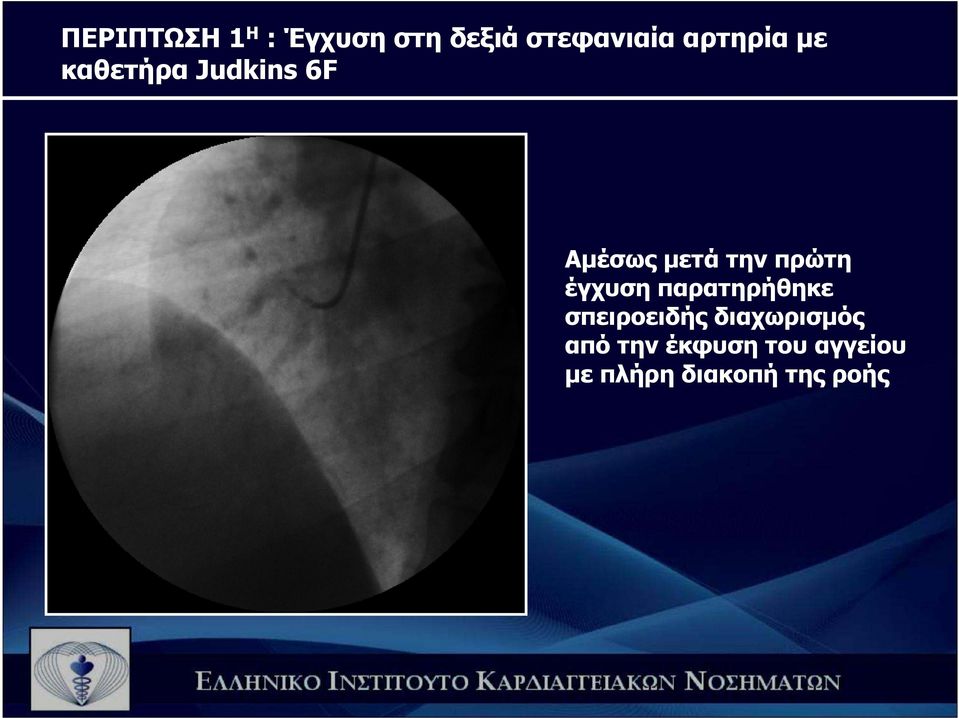 πρώτη έγχυση παρατηρήθηκε σπειροειδής