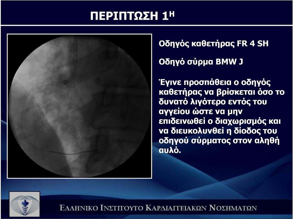 λιγότερο εντός του αγγείου ώστε να µην επιδεινωθεί ο