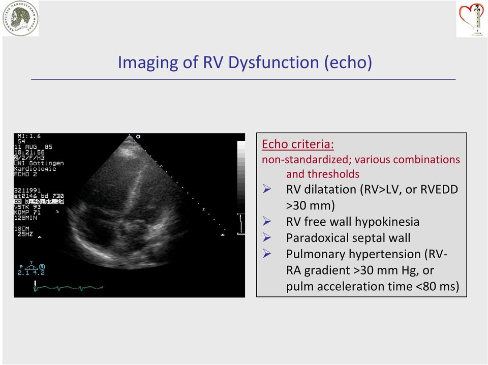 >30 mm) RV free wall hypokinesia Paradoxical septal wall Pulmonary