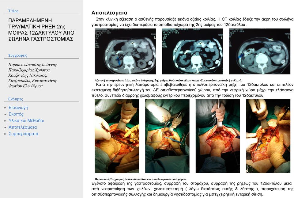 Κατά την ερευνητική λαπαροτομία επιβεβαιώθηκε η οπισθοπεριτοναϊκή ρήξη του 12δακτύλου και επιπλέον εκτεταμένη διήθηση/συλλογή του ΔΕ οπισθοπεριτοναϊκού χώρου, από την νεφρική χώρα μέχρι την ελάσσονα