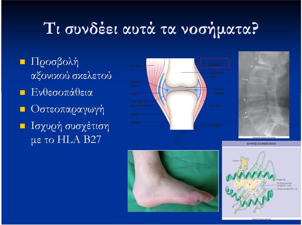 Ενθεσοπάθεια Οστεοπαραγωγή