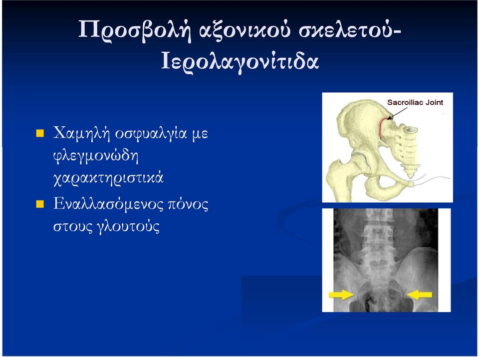 οσφυαλγία με φλεγμονώδη