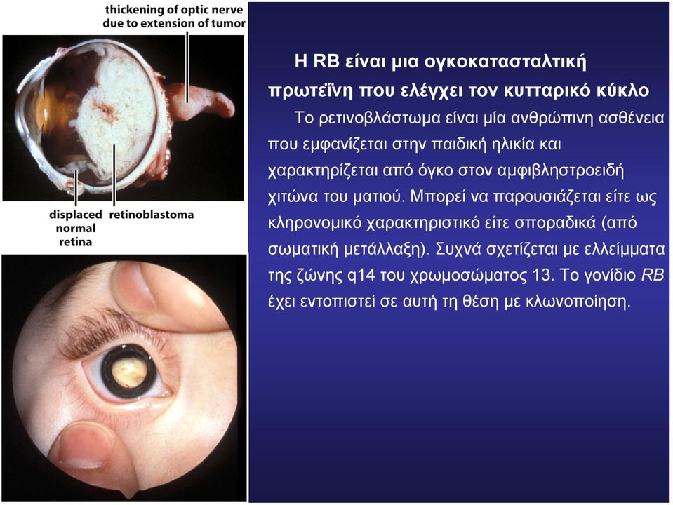 Μπορεί να παρουσιάζεται είτε ως κληρονοµικό χαρακτηριστικό είτε σποραδικά (από σωµατική µετάλλαξη).